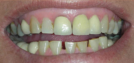 Customer from Marbella requested bright shining teeth